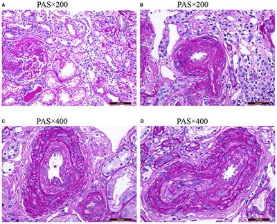 Clinicopathological Characteristics and Influencing Factors of Renal Vascular Lesions in Anti-neutrophil Cytoplasmic Autoantibody-Related Renal Vasculitis